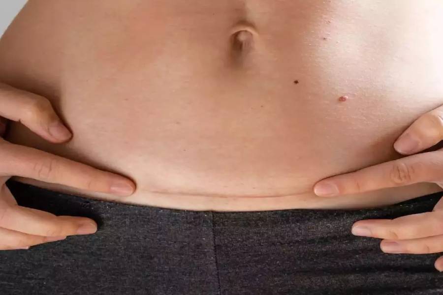 LSCS Delivery Care in Ravet, PCMC, Pune at Kolte Hospital