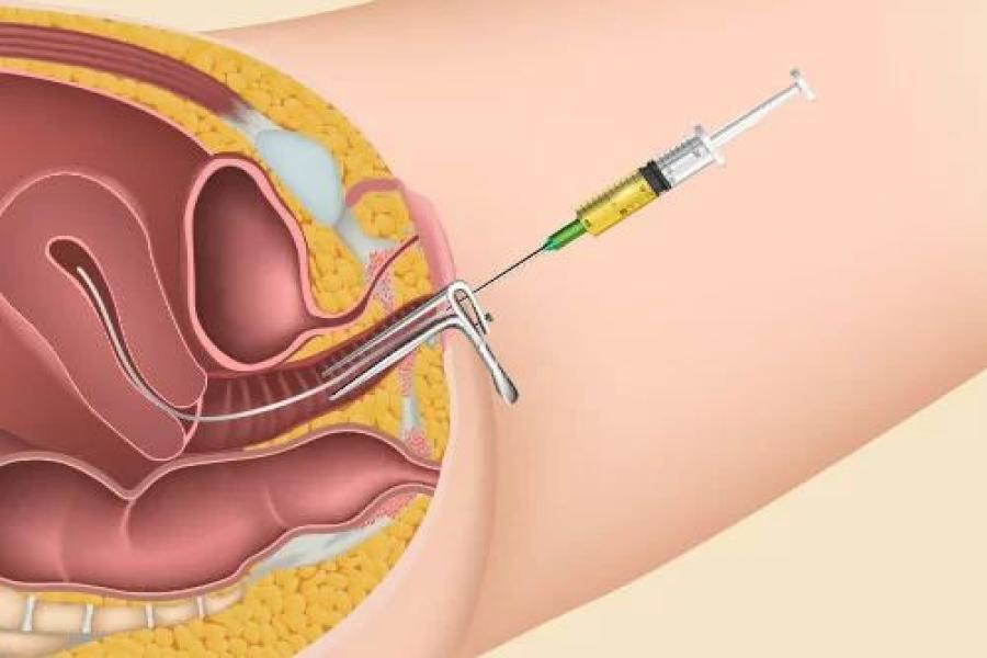 IUI procedure placing sperm directly into uterus during ovulation